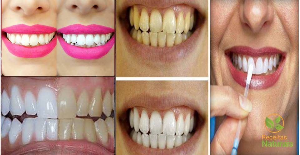 Tenha dentes brancos como nunca usando este método caseiro poderoso e barato