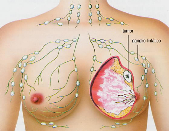 Principais causas do câncer de mama