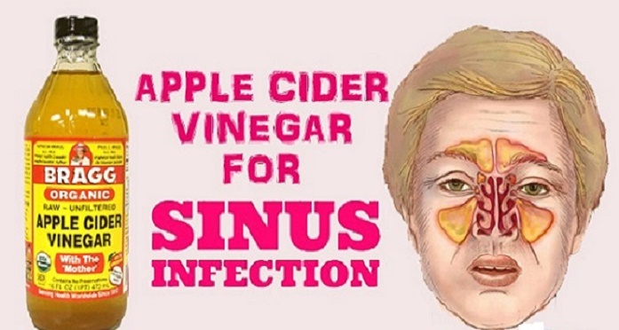 Fim da sinusite e alergias com vinagre de maçã