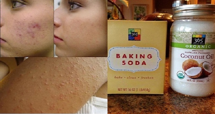 Mistura de bicarbonato e óleo de coco limpa profundamente a pele e combate acne e cicatrizes