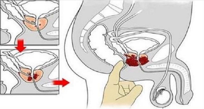 Como o gengibre combate o câncer de próstata, de ovário e de cólon