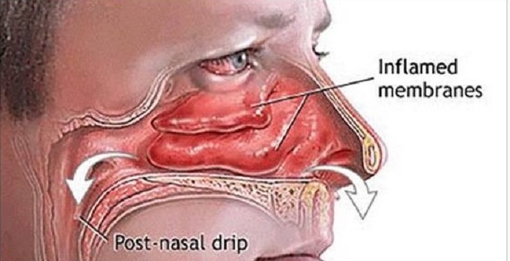 Como tratar a sinusite e limpar os seios nasais em segundos usando apenas os seus dedos