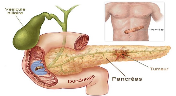 5 sintomas para detectar o câncer de pâncreas