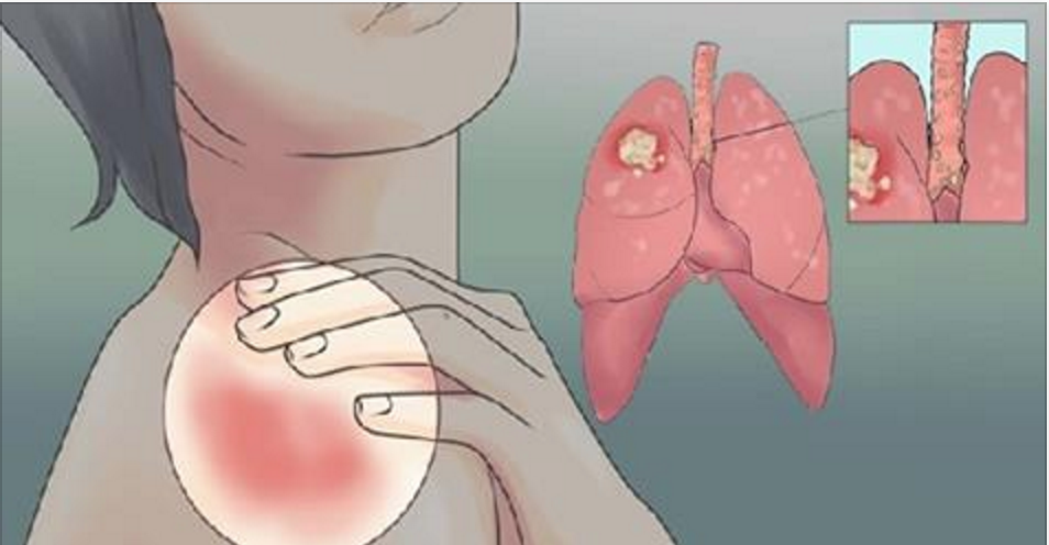 Os 8 primeiros sinais do câncer de pulmão conhecê los pode salvar uma vida!