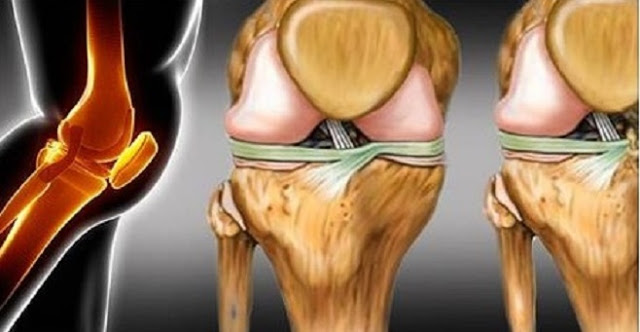 Como recuperar de forma natural a cartilagem danificada do quadril e joelhos