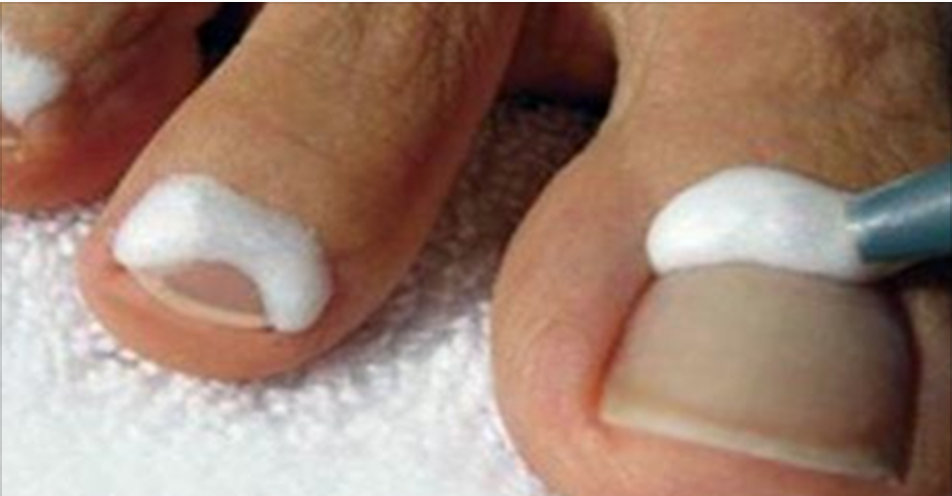 Esta simples mistura elimina rapidamente fungos das unhas dos pés e das mãos