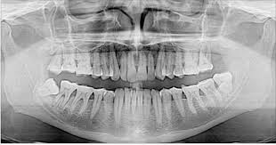 Adeus, implantes dentários: revolucionário técnica faz dente crescer sozinho em apenas 9 semanas!
