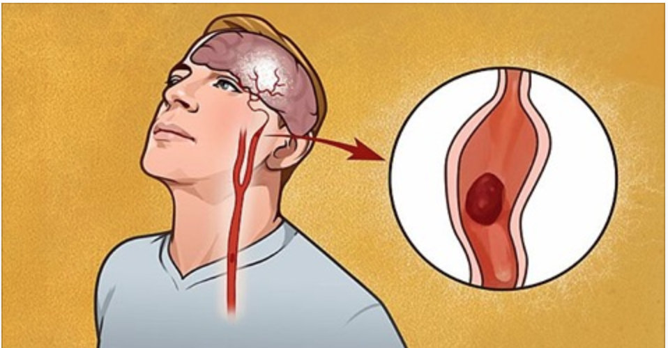 Os 7 primeiros sinais de aviso de um acidente vascular cerebral que todo mundo deveria saber!