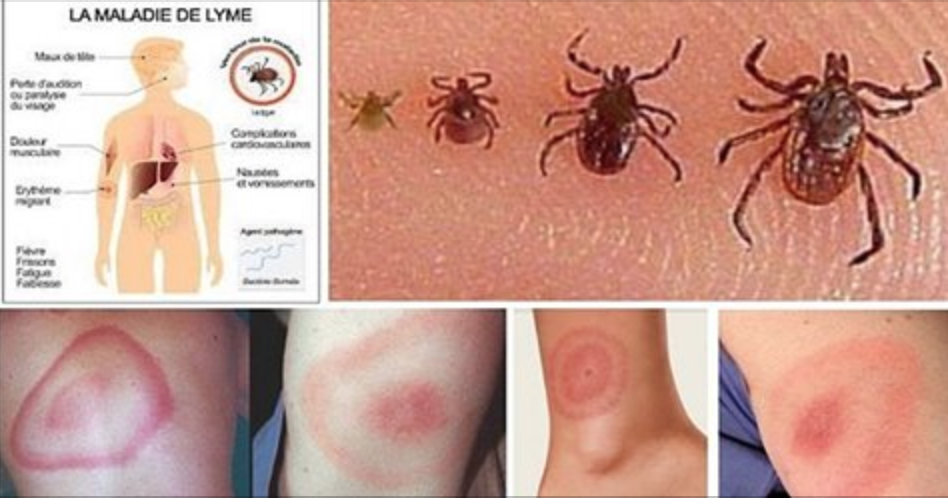 A doença de Lyme: a ameaça que está se espalhando pelo mundo e todos precisam conhecer!