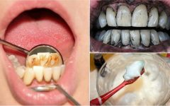 3 tratamentos eficazes para remover o tártaro dos dentes