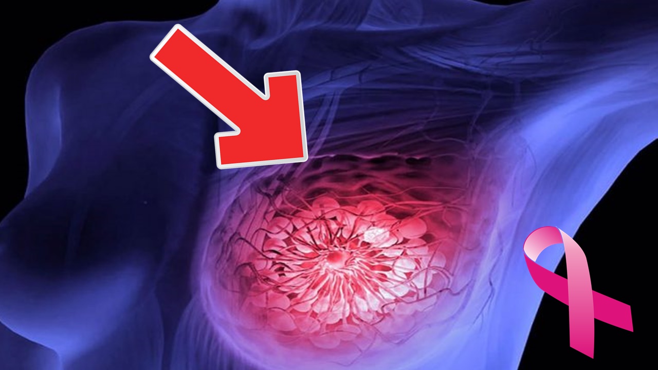 Um caroço não é o único sintoma de câncer de mama. Aqui estão mais 7 sinais