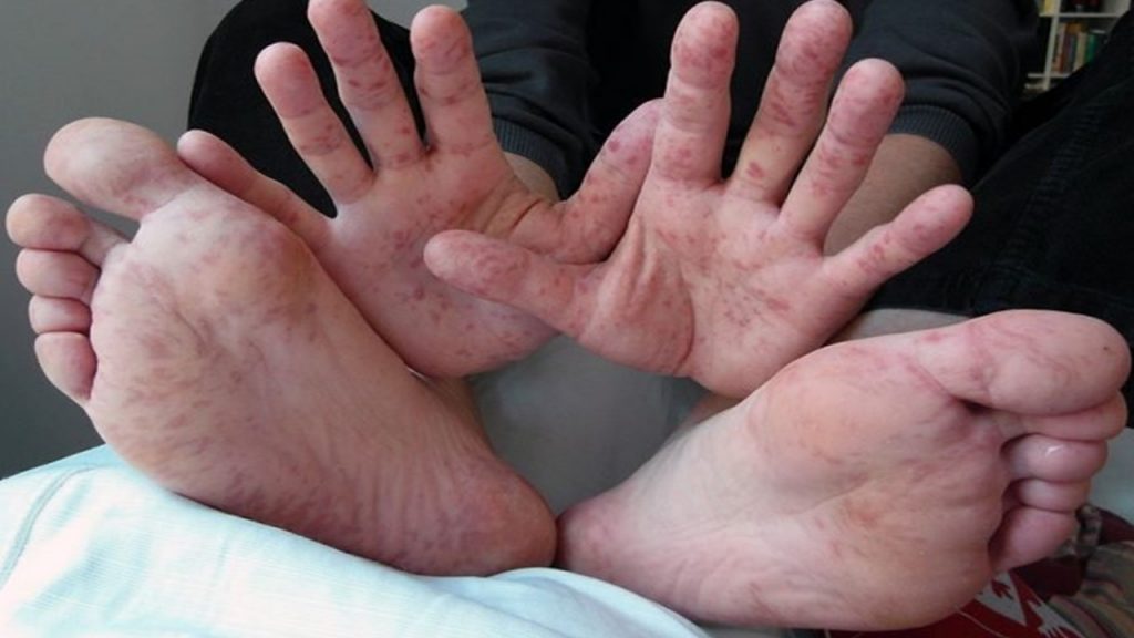 Síndrome mãopéboca conheça os sintomas e como tratar Receitas Naturais