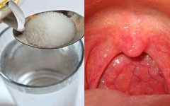 12 remédios naturais para aliviar rapidamente a dor de garganta
