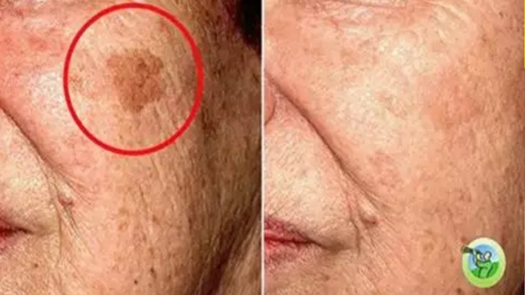 5 remédios caseiros que vão eliminar qualquer problema de pele do seu rosto!