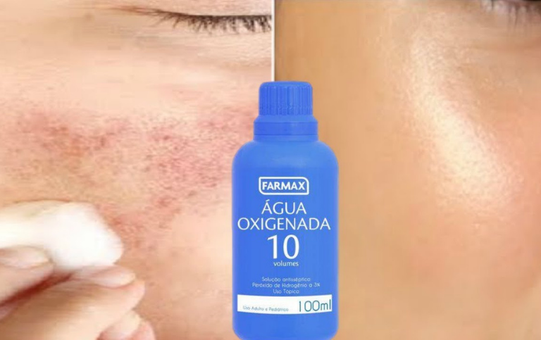 Como tirar manchas do rosto com água oxigenada 10 volumes e bicarbonato