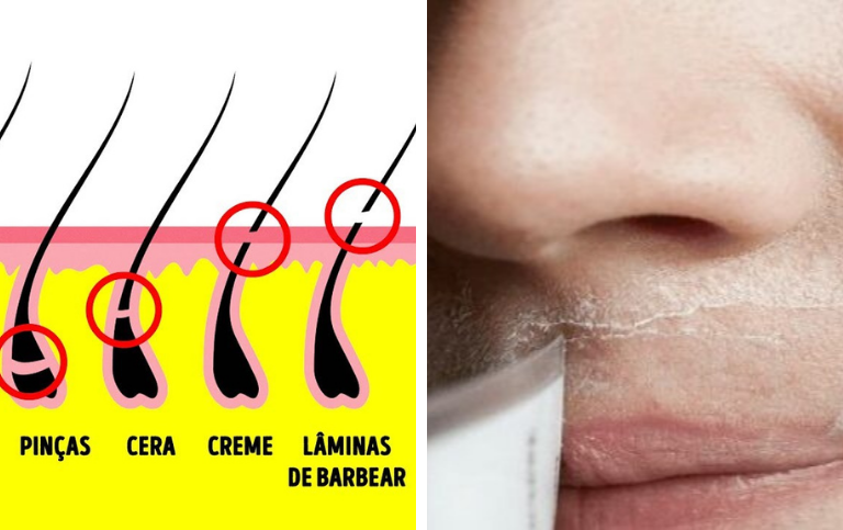 Para mulheres: livre-se do “bigode” e de pelos no rosto para sempre com esta receita natural