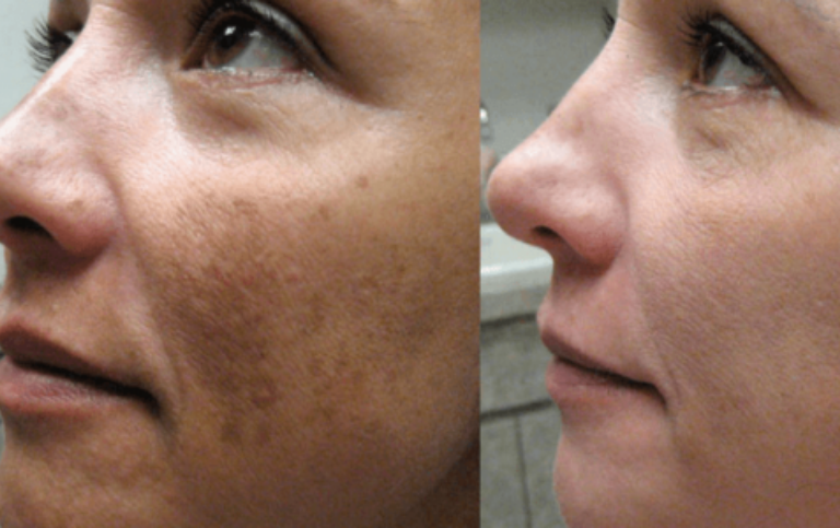 Receita caseira para clarear e remover manchas da pele e Melasmas