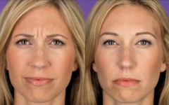 Poderoso Botox caseiro para o rosto: 3 melhores receitas naturais