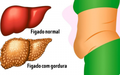 6 Sinais de Gordura no Fígado ou Esteatose hepática