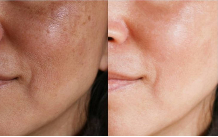 Como Clarear e Remover suas Manchas escuras na pele, Rugas e Melasmas