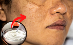 Remédios Caseiros para ajudar a tratar manchas escuras e melasma na pele