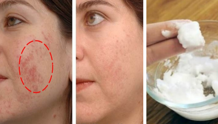 Receitas naturais para clarear a pele e remover manchas escuras