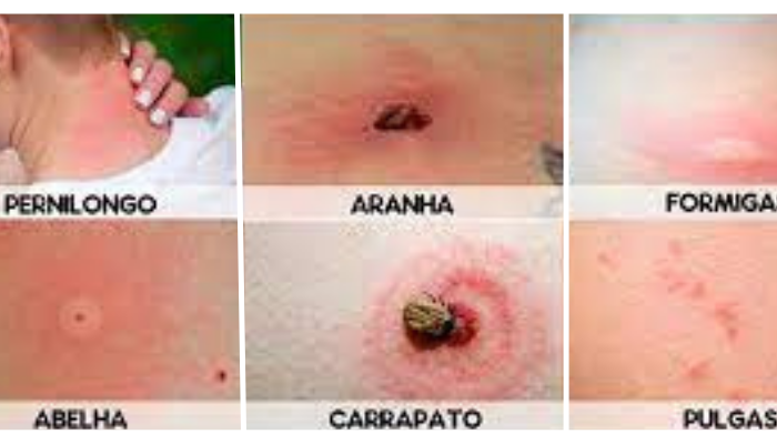 Como identificar as picadas de inseto mais comuns
