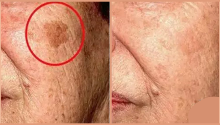 Receita Para Remover Manchas Escuras