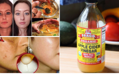 7 maneiras de usar vinagre de maçã para acne e manchas escuras