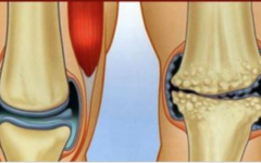 6 anti-inflamatórios naturais para tratar e curar dores nos joelhos e articulações!