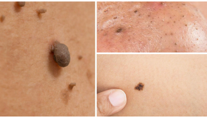 Eliminar sinais, verrugas, cravos, fibromas e manchas de idade naturalmente
