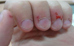 Onicofagia: Compulsão em roer unhas é sinal de alerta!