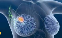 Médicos descobrem tratamento que elimina completamente câncer de mama em estágio inicial