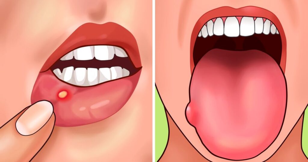 Conheça as 7 doenças mais comuns na boca