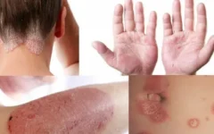 Os Melhores Remédios Naturais para Eliminar Eczema, Psoríase e Outras Doenças de Pele